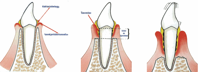 Periodontitt – tannløsningssykdom
